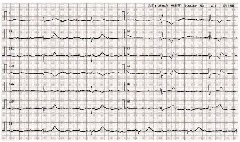 心电图图库丨(高度)三度房室传导阻滞系列 - 知乎