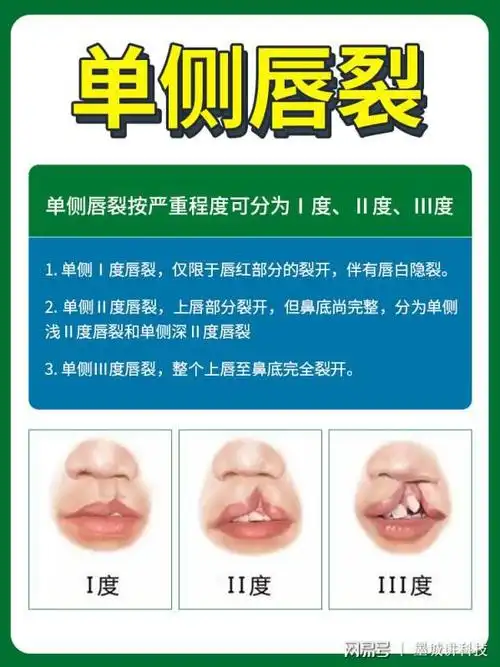 余文林唇裂鼻是否能够完美修复这点尤为重要