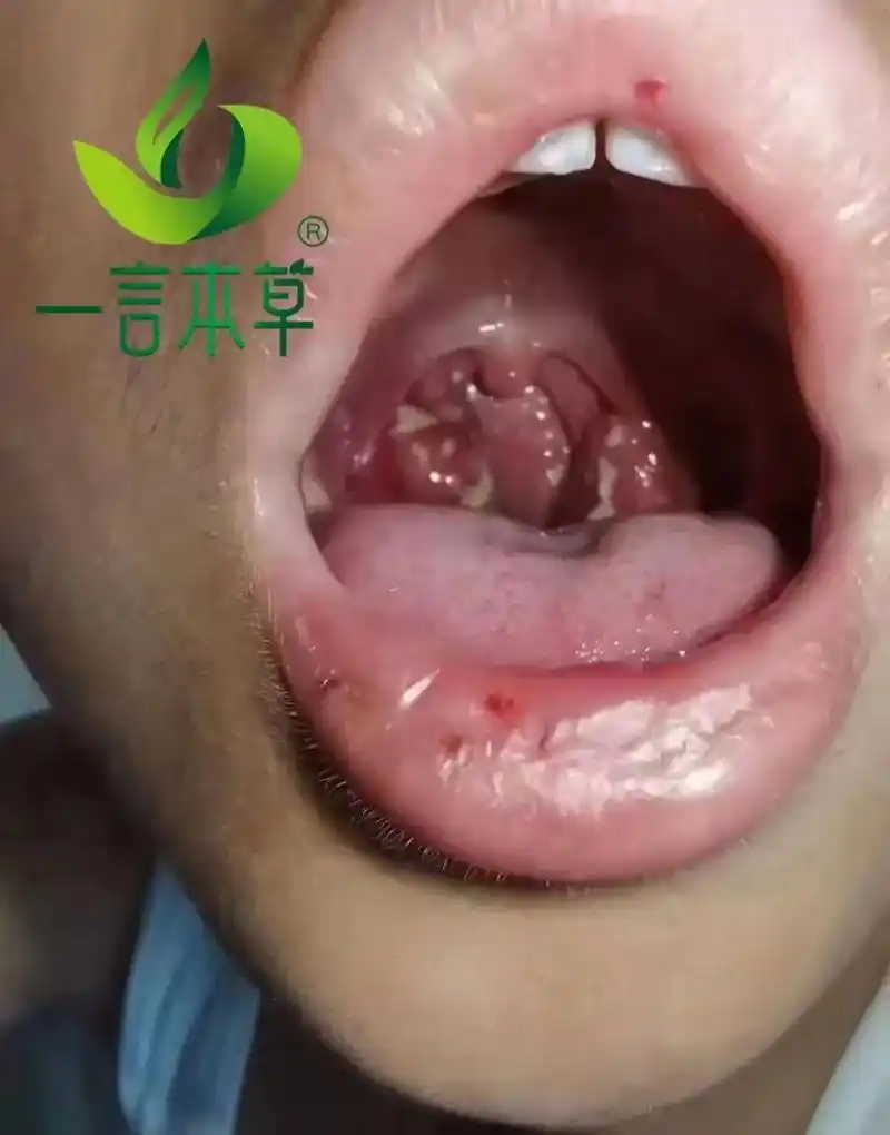 扁桃体肿大如何预防.#扁桃体肿大,腺样体肥大都是吃出来的富贵 - 抖音