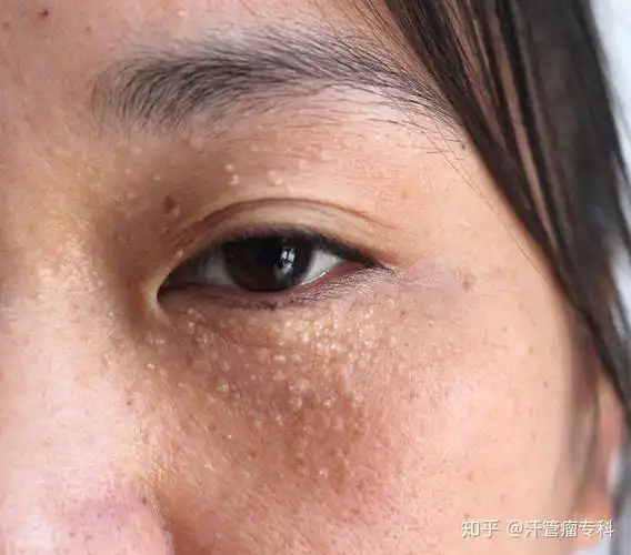 长汗管瘤的原因