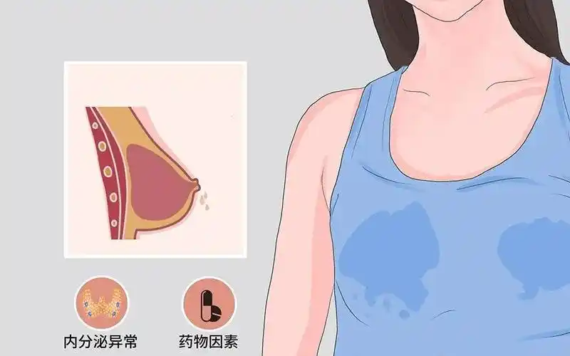 癌引起最常见皮肤改变位肿瘤侵犯乳房悬韧带后与皮肤粘连,出现酒窝征