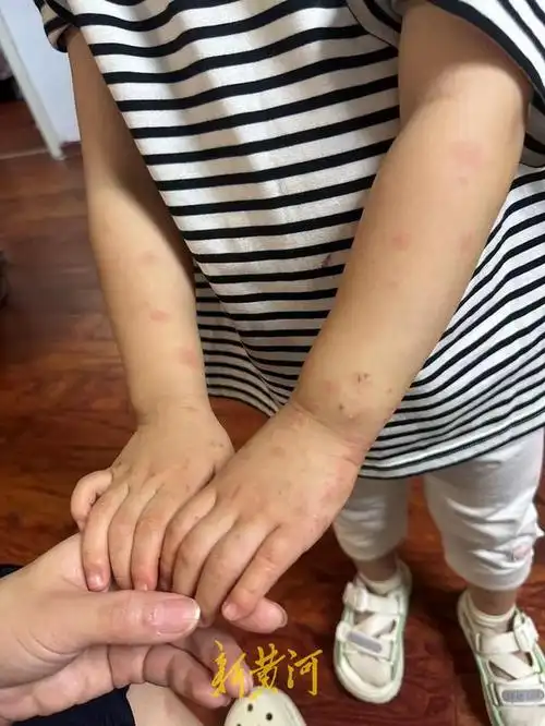 出租房内3岁孩子被床虱咬伤,房东称房子移交完毕不清楚来源