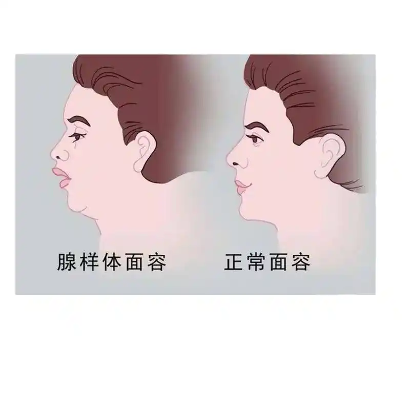 孩子长期张口呼吸小心腺样体面容.