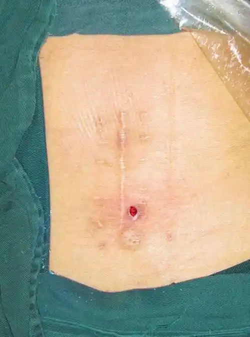 提供一例小开窗和内窥镜手术后患者的伤口照片请参考