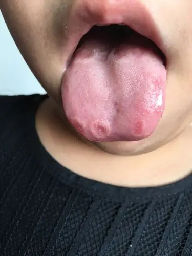 亲戚家小孩已经上幼儿园,今天看到她舌头是这样的,是不是缺少微量元