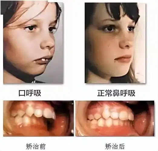 杏林微科普您知道什么是口呼吸吗