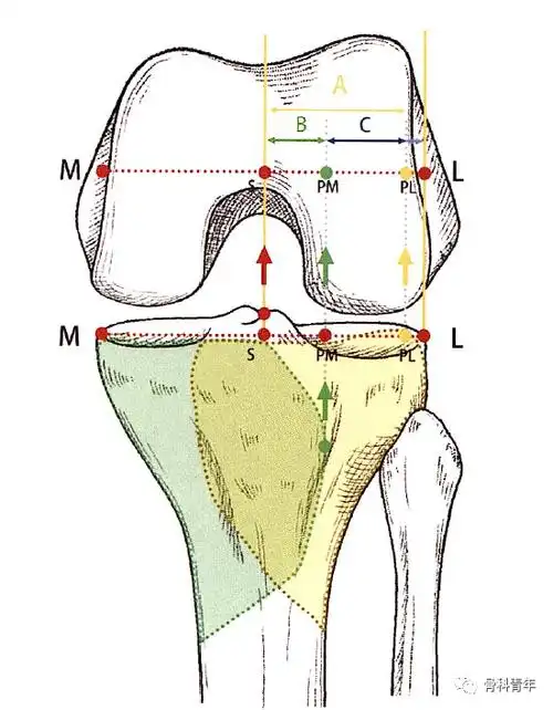 暴露胫骨平台后柱的手术入路|胫骨|骨折|暴露|部分|外侧|-健康界