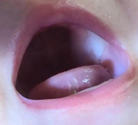 口腔上牙肉白色的正常吗?_百度宝宝知道