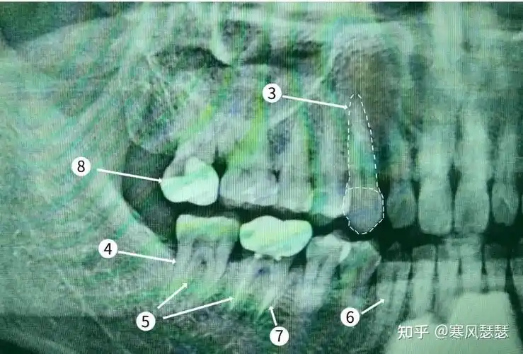 教你读懂自己的口腔x光片