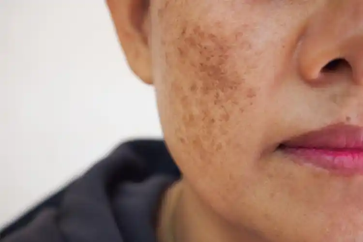 脸上黑斑点图片