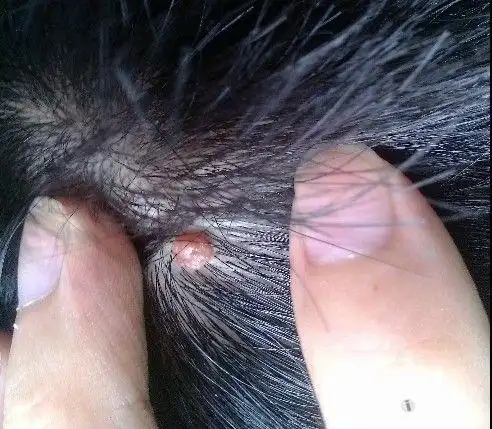 症状二:白天比较嗜睡,有时候头会昏昏沉沉的,记忆力下降,很容易走神.