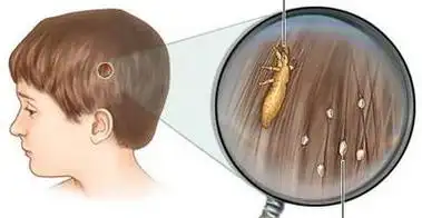 头上有虱子,有什么简单的方法