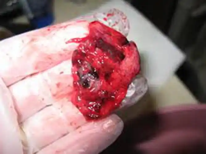 早孕药流排出的孕囊形状图片