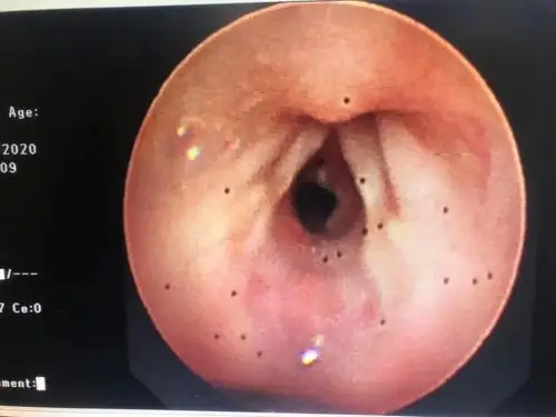 婴儿哭闹不吃奶检查发现婴儿这里居然只有米粒大小空隙