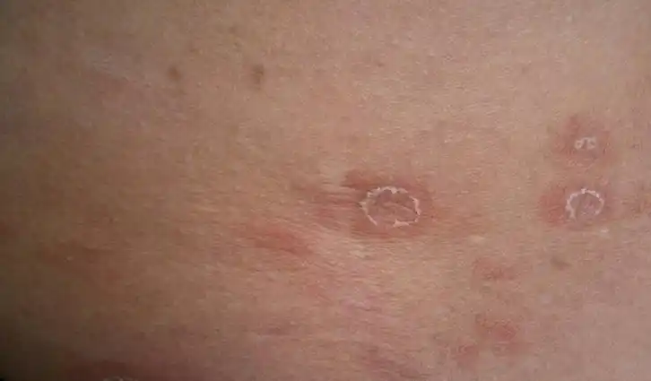 三 玫瑰糠疹与银屑病的鉴别