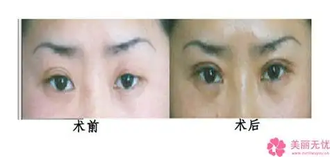 李华平眼睛斜视须手术整形作用维持时间几个月2024-02-24每一个爱美的