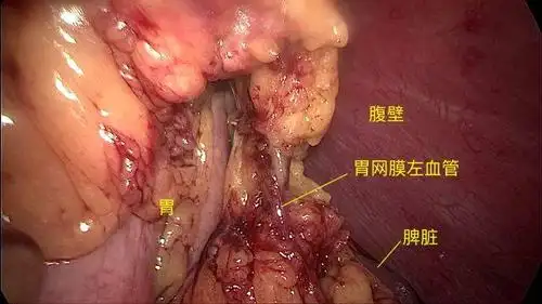 腹腔镜胃癌全胃切除术(稍有血腥,饭前慎看!