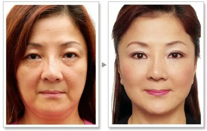 不超过5~10个单位为原则,必要的时候可以搭配少许的玻尿酸做填充辅助