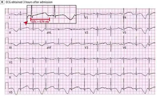 心电图解析:致命的先天性qt间期延长