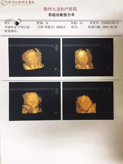 双胎宝妈21周做四维彩超筛查出一名胎儿为唇腭裂