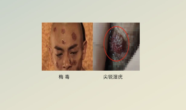花柳病是什么症状常见花柳病图片主要有哪几种