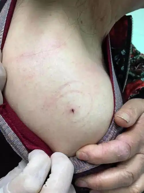 惊险女子踏青蜱虫钻入皮肤南京医生妙手捉虫视频慎入