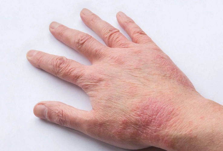 【湿疹症状图片】_表现_种类_苹果绿