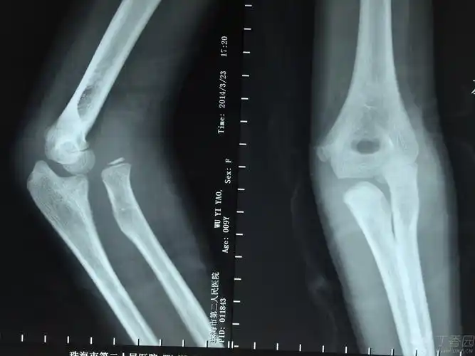 桡骨小头脱位,请求治疗方案