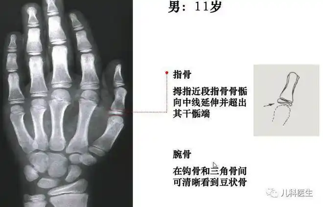 男孩的骨龄图谱   骨龄评测方法