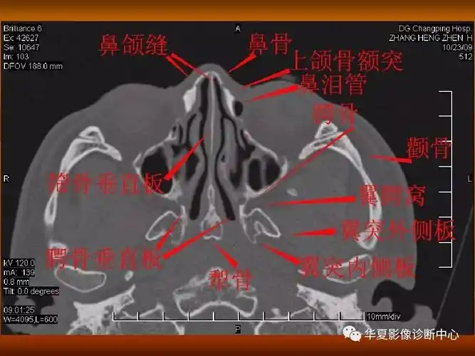 最全的颅骨ct解剖及外伤骨折的诊断(下)