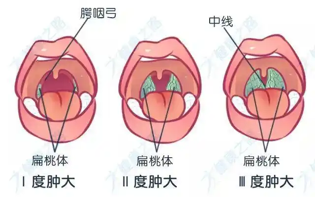 ③扁桃体肿大一般分为三度②1岁末逐渐增大,4～10岁时发育达最高峰.