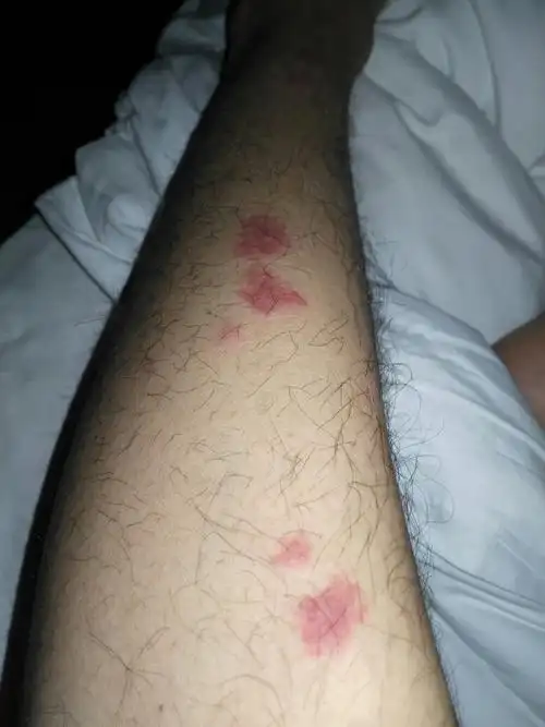 这是什么虫子咬的啊,痒死了.什么药可以治好啊?