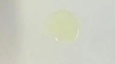 尿道口外排白色液体有以下原因