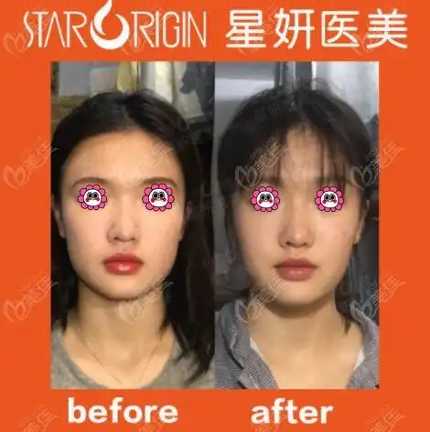 大连星妍注射瘦脸针瘦脸真人前后对比照