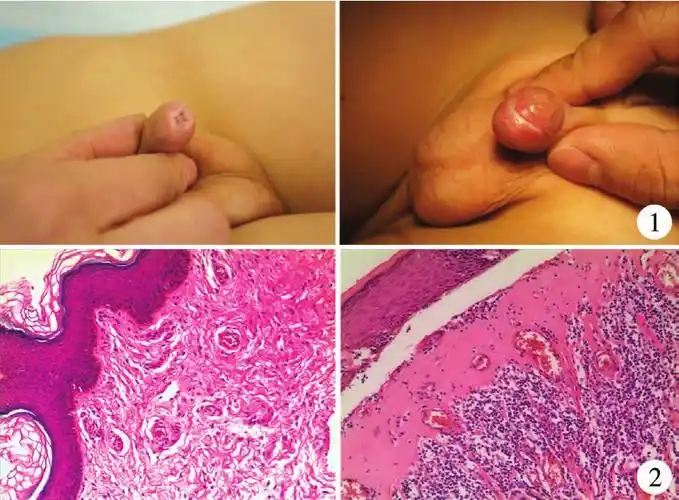 干燥性闭塞性龟头炎儿童时期发病特点分析