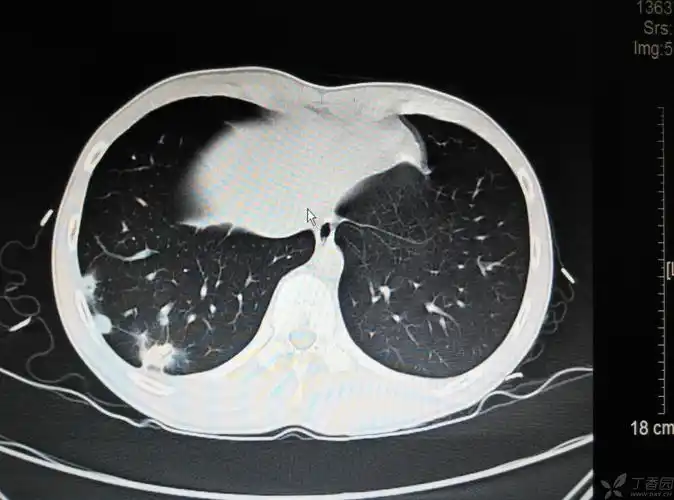【影像读片】16岁男孩,体检时发现右肺空洞,无任何症状