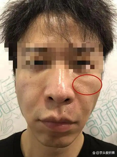 印第安纹,又叫破颧纹,是指眉毛以上,眼睛以下的脸部区域出现的横向