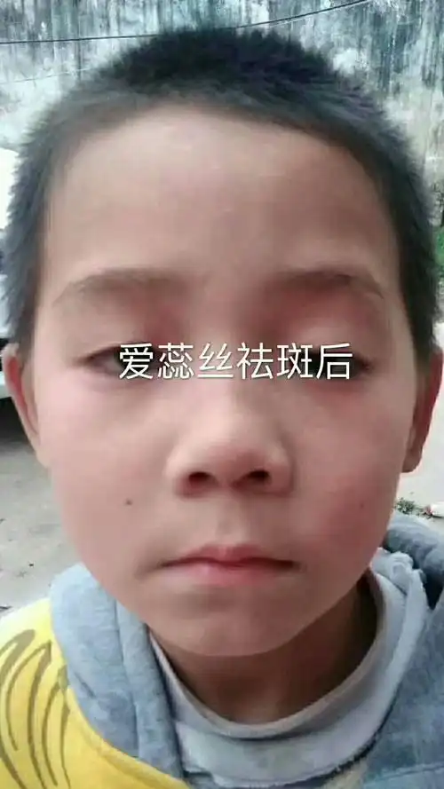 全城寻找雀斑宝宝,暑期大优惠.