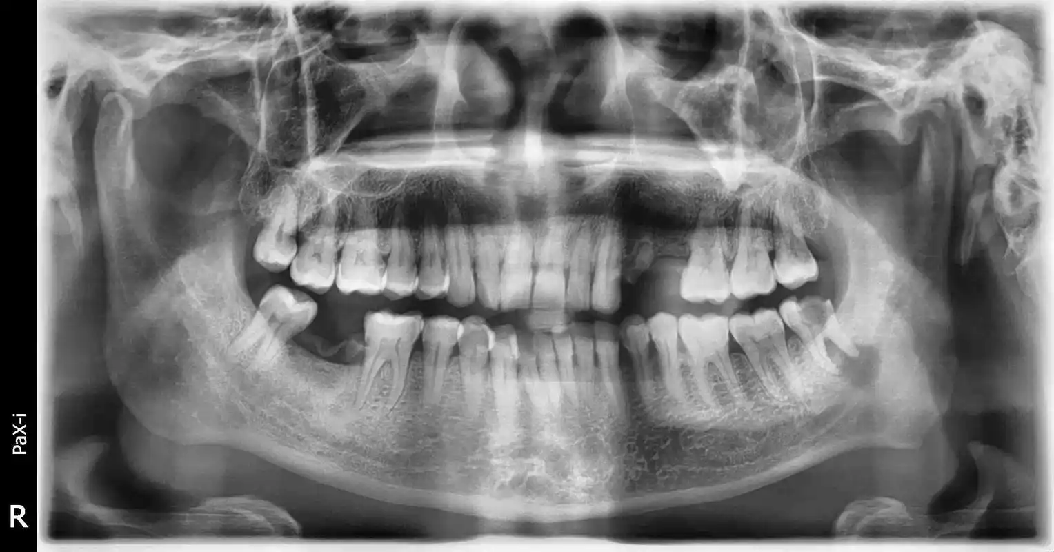左下侧尾齿蛀牙疼痛期间半年左右反复发作x光片显示牙齿下方有阴影