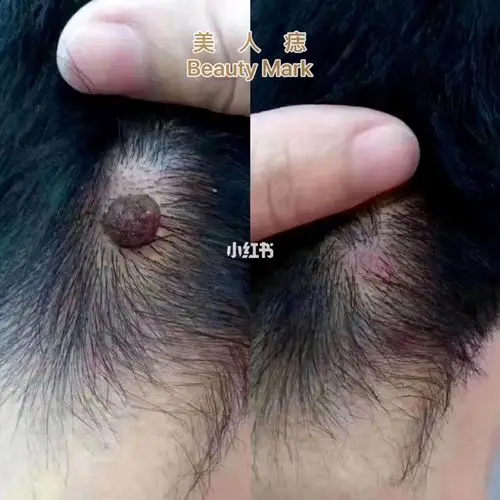 发中疣祛除对比73