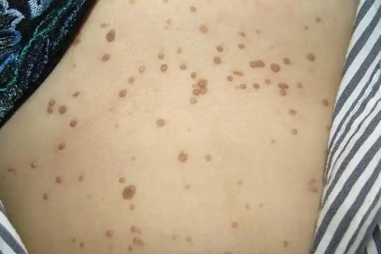 男性hpv真实图片初期