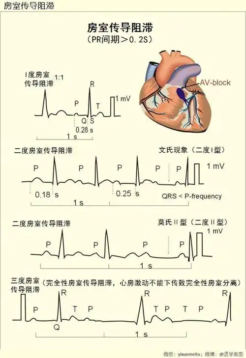 重症之声.icu第一利器:床旁心电图运用之二:房室传导阻滞
