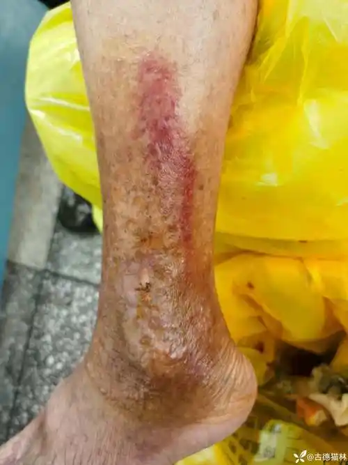 丹毒还是蜂窝织炎