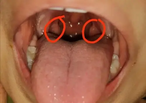 腺样体肥大有完没完?