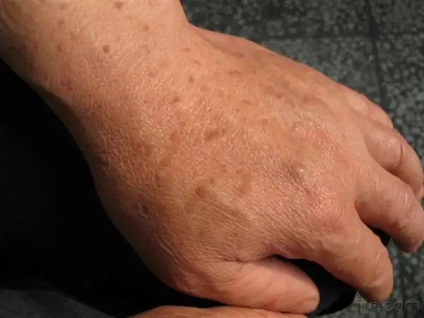 手背多发性小斑丘疹20年,不痛不痒,越来越多.是扁平疣吗?