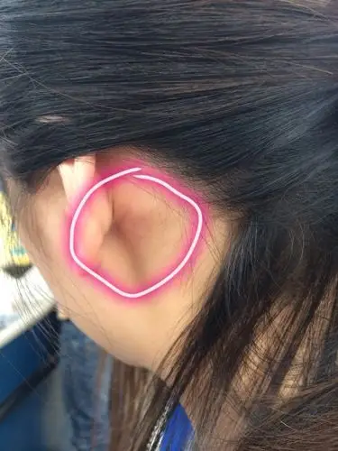 耳朵后面有一块骨头凸起的,伴随着软软的东西,是什么呢?两边耳朵都有