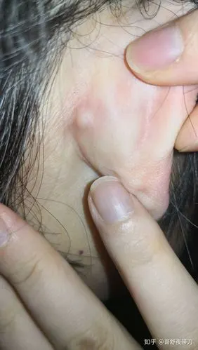 耳朵后面长了个包是什么