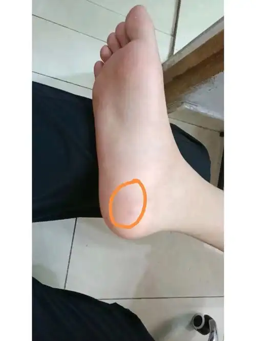 足底筋膜炎求救命