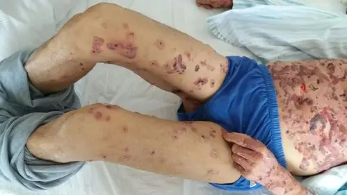 大疱性类天疱疮