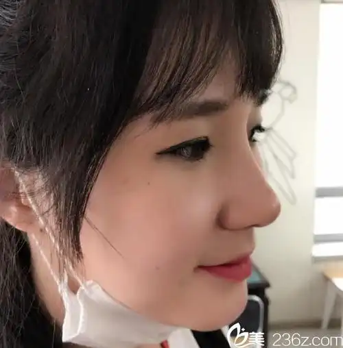 崔元驲 鼻综合真人案例